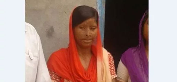 तेजाब-ने-उसकी-आंखों-की-रोशनी-छीन-ली