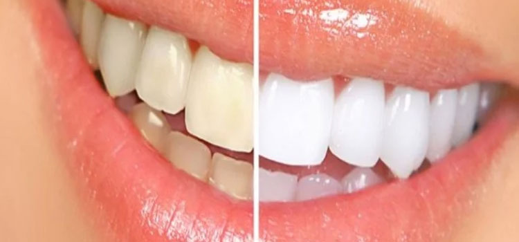 Whiten Teeth